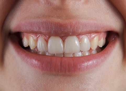 Coloration des dents, Dents jaunes, Blanchiment des dents