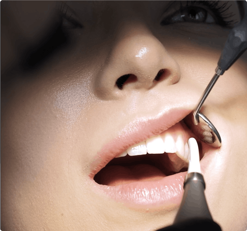 gel prossional, clareamento dental