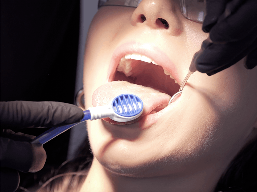 tongue coating, tongue scraper, tongue cleaning, tooth brushing, caries, periodontitis, oral mucosa, gums, coated tongue, interdental spaces, professional tooth cleaning, gingivitis, food residues, dental floss, cleaning of the tongue, oral flora, dental care, poor oral hygiene, bad breath, oral health, discolouration, sulphur compounds, healthy tongue, types of bacteria, alpine white