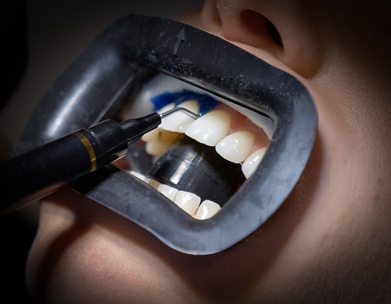 alpine white, clareamento dental, peróxido de hidrogênio, clareamento caseiro, dentes brancos, saúde bucal, sensibilidade nos dentes,