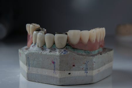 Alpine White, coroas dentárias, coroa dentária, implante dentário, dentes naturais, coroas dentárias, dente natural, saúde bucal, higiene bucal, tipos de coroa, prótese dentária, tipos de coroas, coroa de porcelana, ponte dentária, coroa provisória, coroas de porcelana, estrutura interna, creme dental, tratamento odontológico, estrutura metálica, aparência natural, coroas de resina, prótese provisória, canal radicular, pontes dentárias