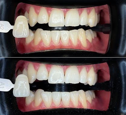 bleaching, bleaching zurich, teeth whitening
