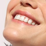 bleaching, bleaching zurich, teeth whitening