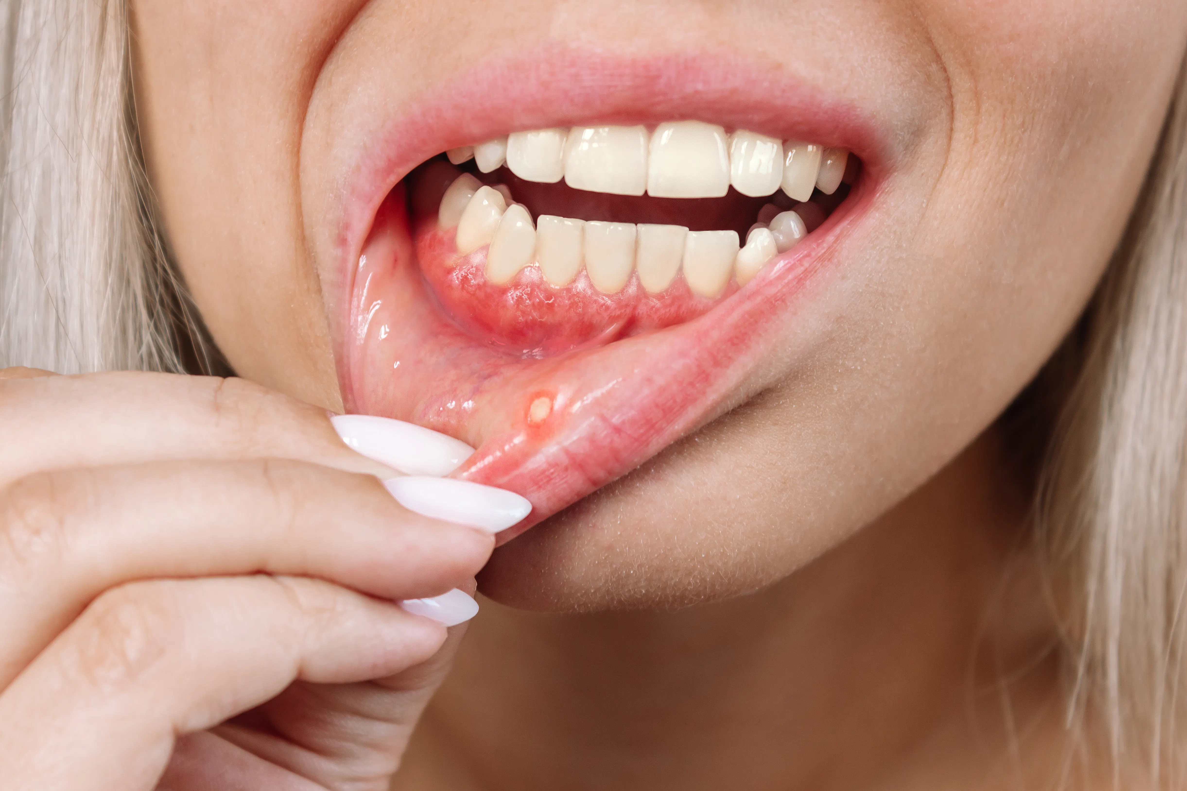 The image focuses on a close-up view of a woman’s open mouth, specifically highlighting a canker sore located on the inside of her lower lip.
