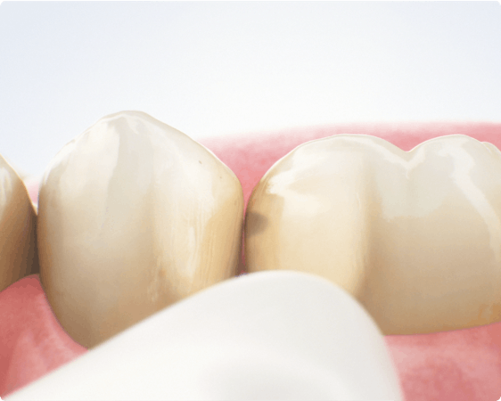 Karies Kontrolle der Zähne