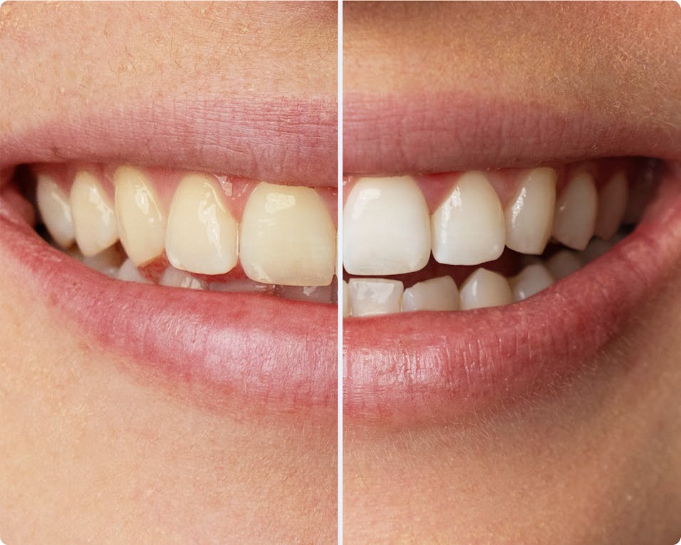 Alpine White, Whitening Kit, Before & After