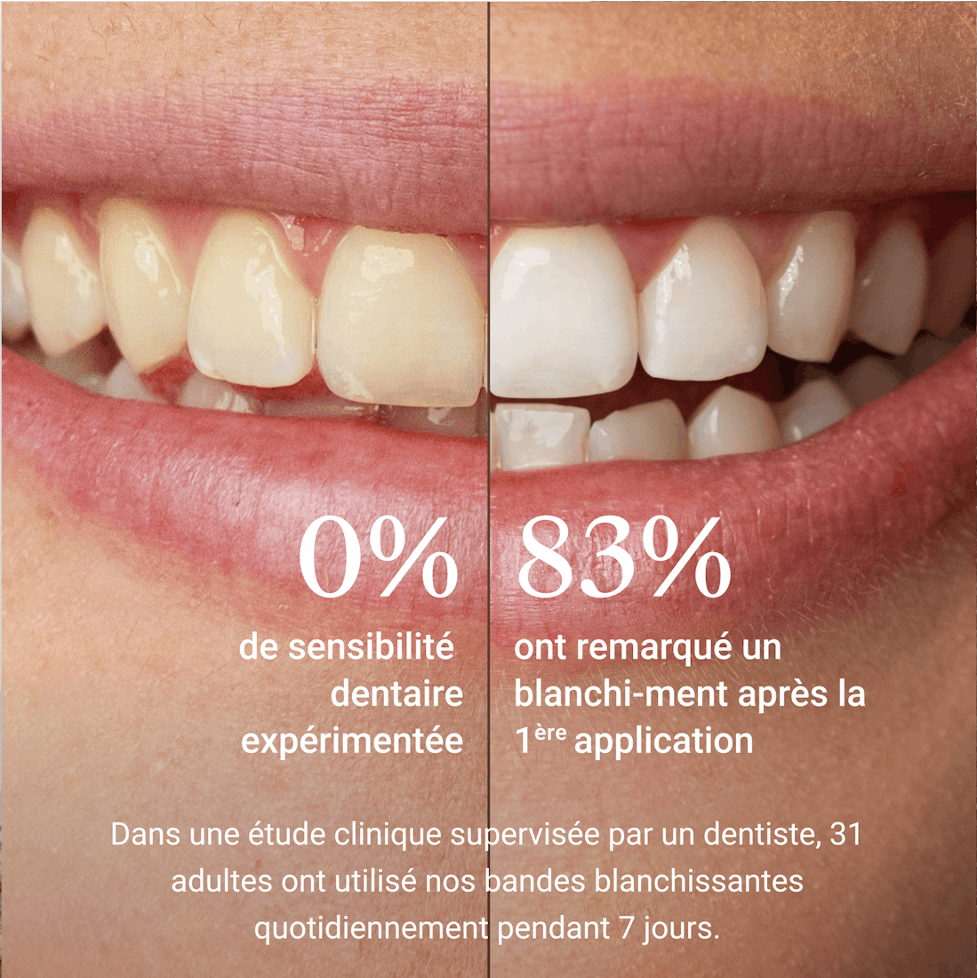 Bandes de blanchiment, bandes blanchissantes, Bleaching, Alpine White