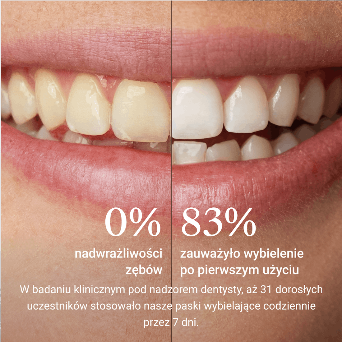 Whitening Strips, Bleaching, Alpine White