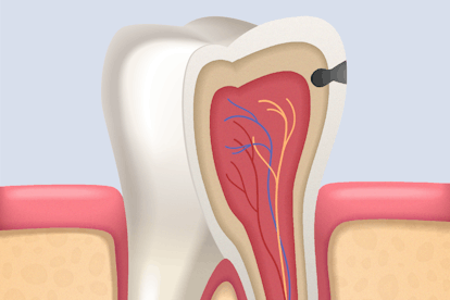 Karies im innern Dentin