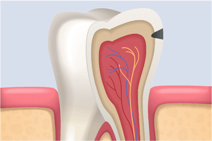 Karies im äusseren Dentin