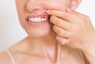 Alpine white, parodontite, sorriso saudável, dentes saudáveis, saúde bucal, higiene bucal, placa bacteriana, clareamento dental, clareamento caseiro, doença periodontal, consultório odontológico, tratamento caseiro, higiene oral, sorriso bonito, creme dental, enxaguante bucal, esmalte dentário, acúmulo de placa, sorriso saudável, base de peróxido, alisamento radicular, perda de dentes, perda dos dentes, restos de alimentos, fitas clareadoras, perda óssea