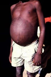 Child affected by schistosomiasis displaying "swollen belly" symptom