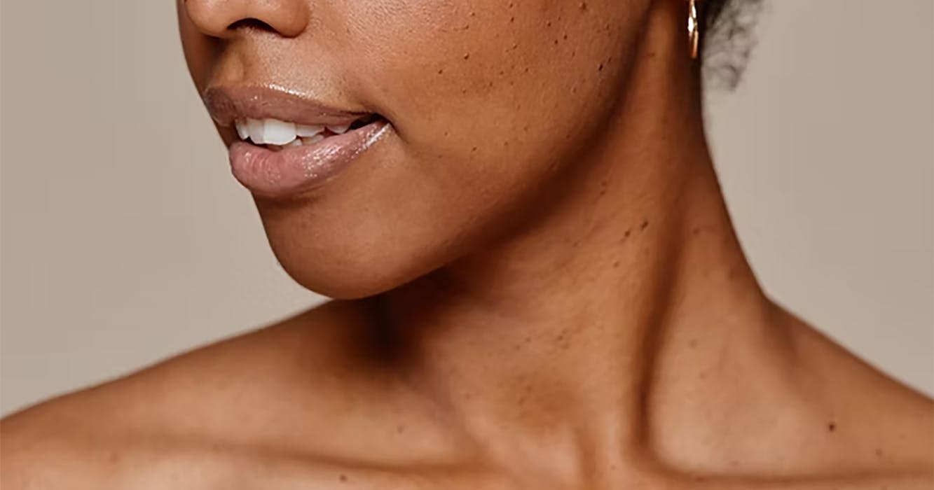 A female following pigment correct peel treatment