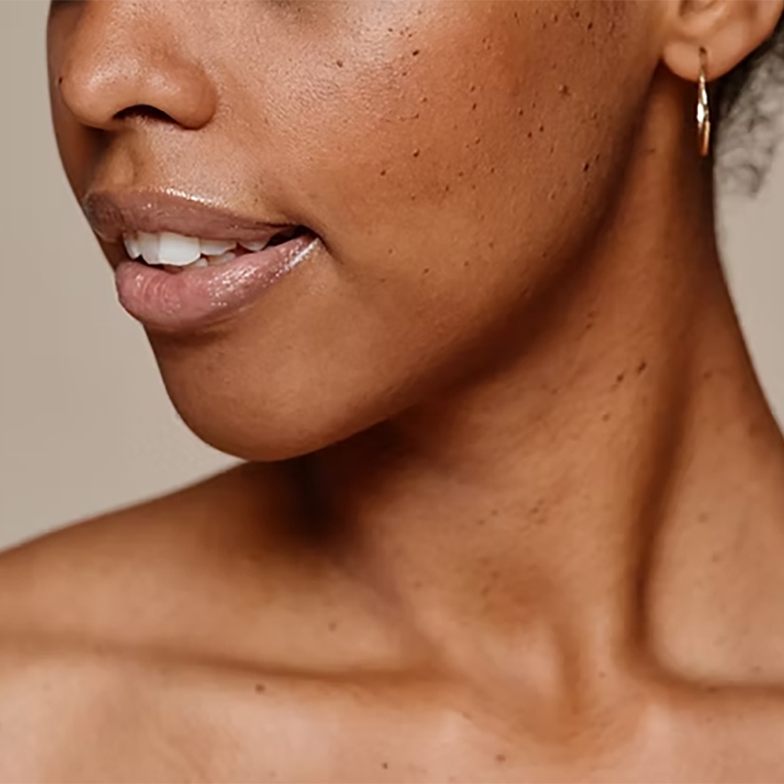 A female following pigment correct peel treatment