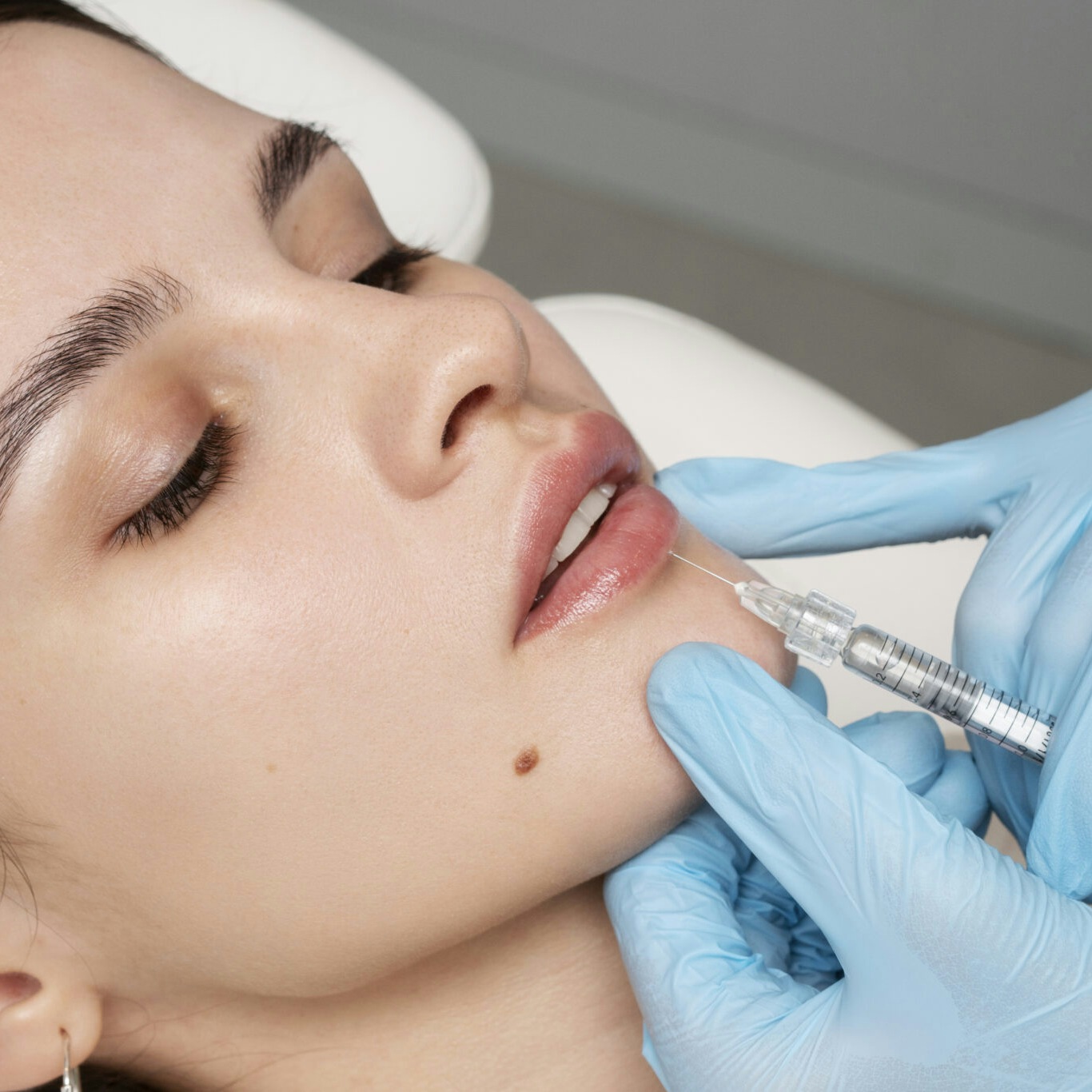 A female patient receiving lip dermal filler treatment