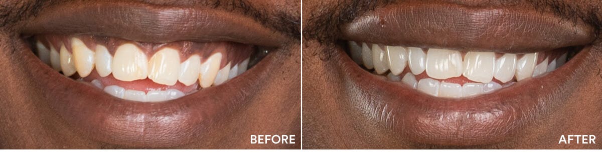 before and after teeth whitening 1