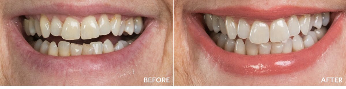 before and after teeth whitening 3