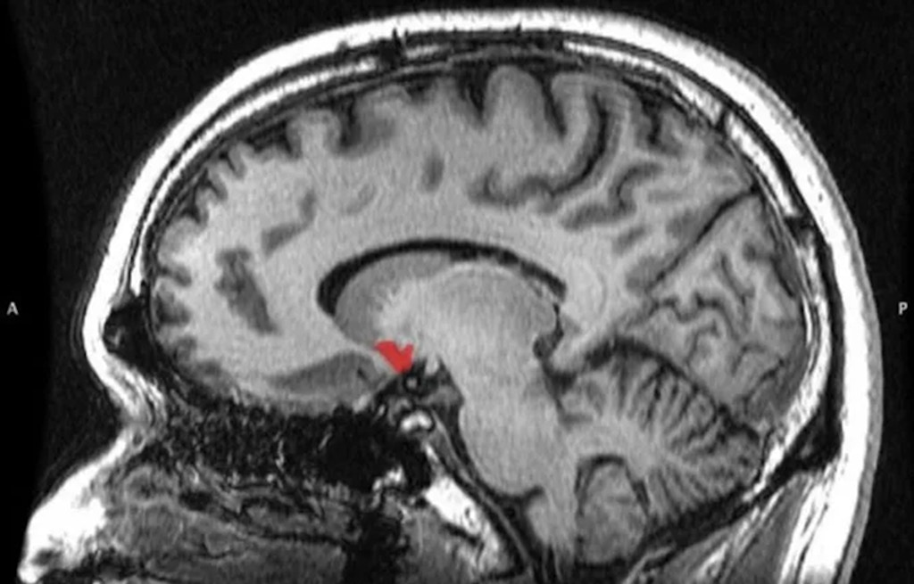 Прилежащее ядро — подстрекатель наших импульсивных покупок. Источник: Popmech.ru
