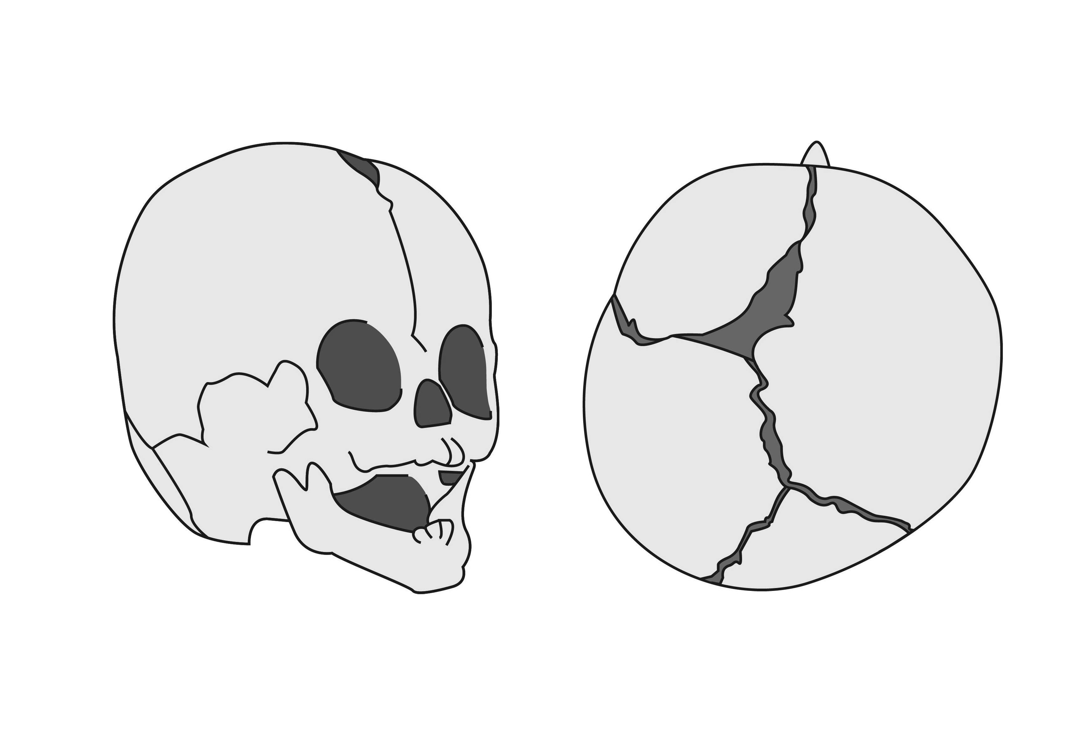 【医師解説】位置的頭蓋変形症と頭蓋骨縫合早期癒合症の見分け方とは？