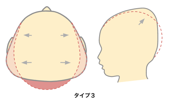 【医師解説】斜頭症や短頭症(絶壁)などの重症度を診断する方法とは?
