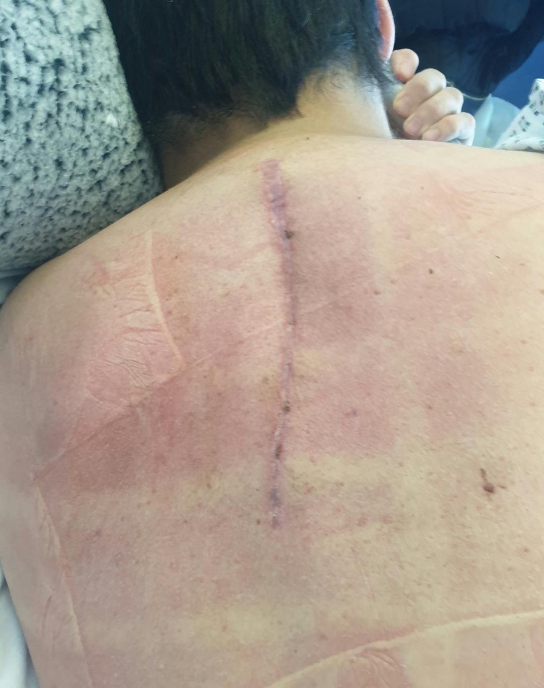 Brandon face down showing long scar on back