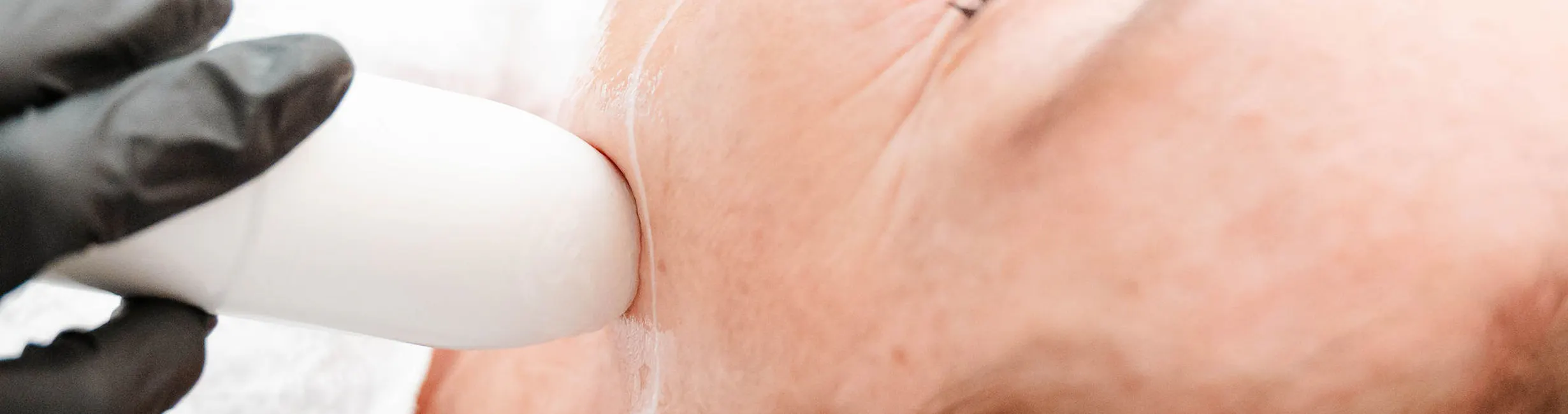 Een klant ondergaat een HIFU-gezichtsbehandeling voor huidversteviging en verjonging, uitgevoerd door een professional in een ontspannen omgeving.