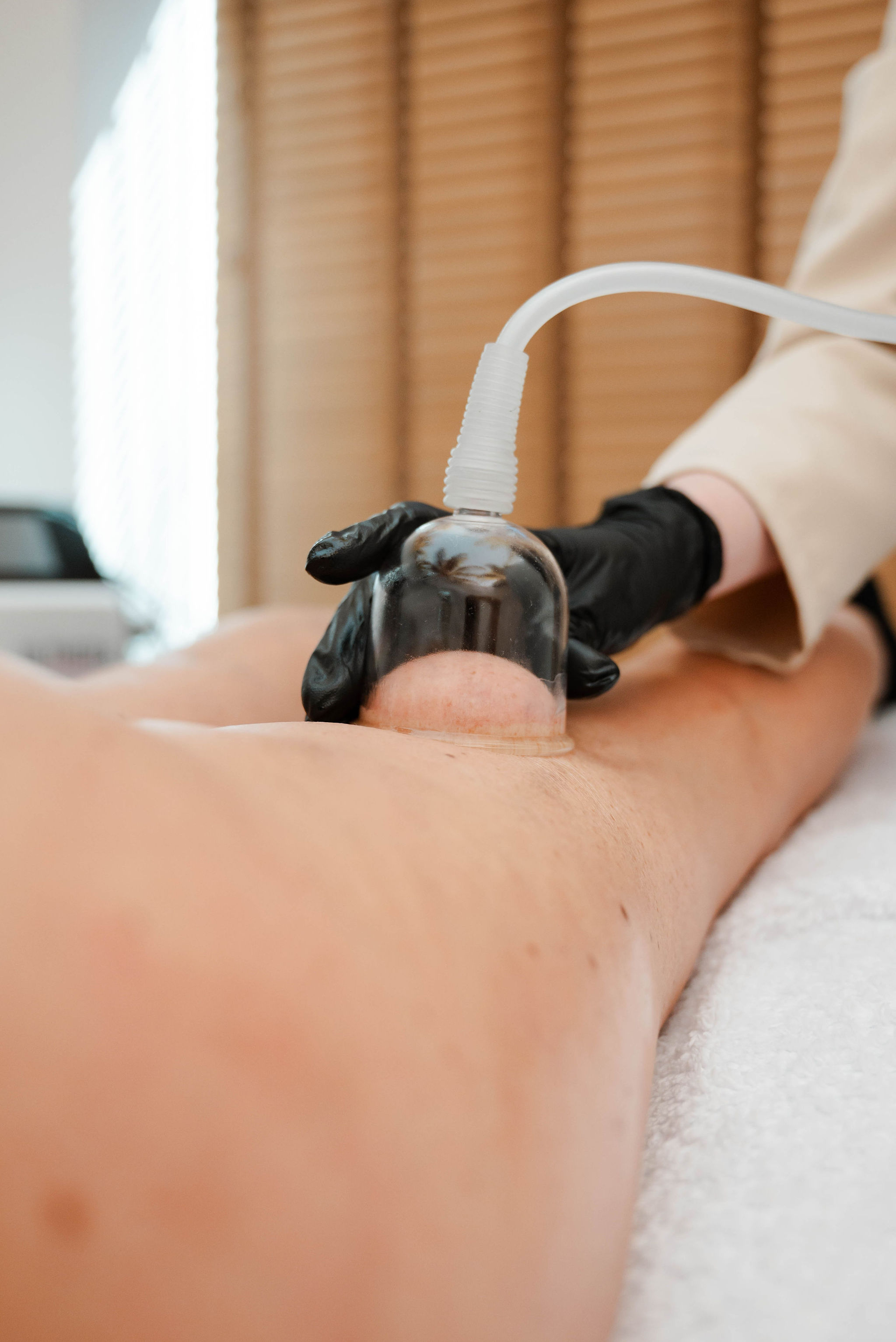 Cupping lichaamsbehandeling op de benen om de doorbloeding te verbeteren en cellulite te verminderen.