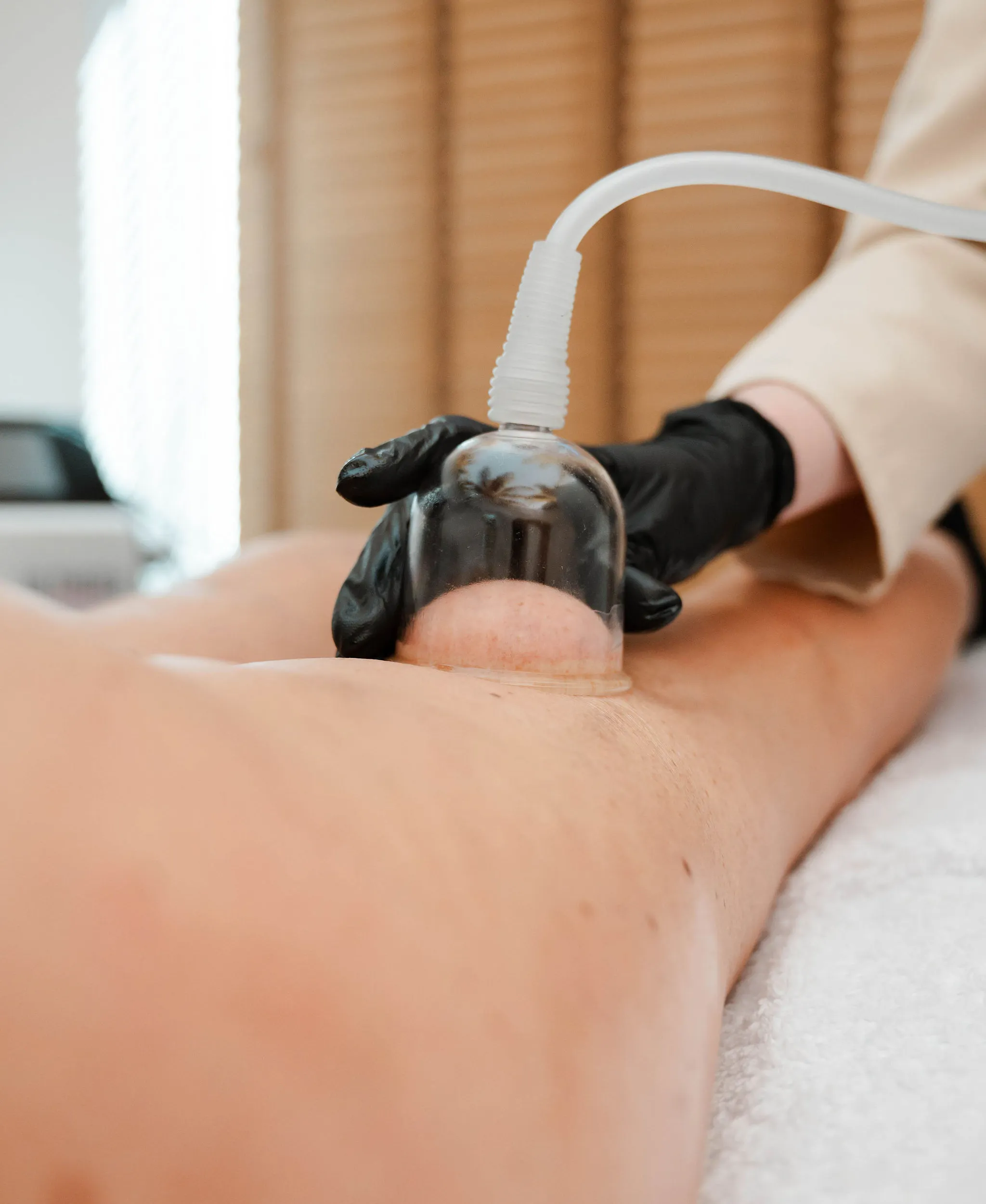 Cupping lichaamsbehandeling op de benen om de doorbloeding te verbeteren en cellulite te verminderen.