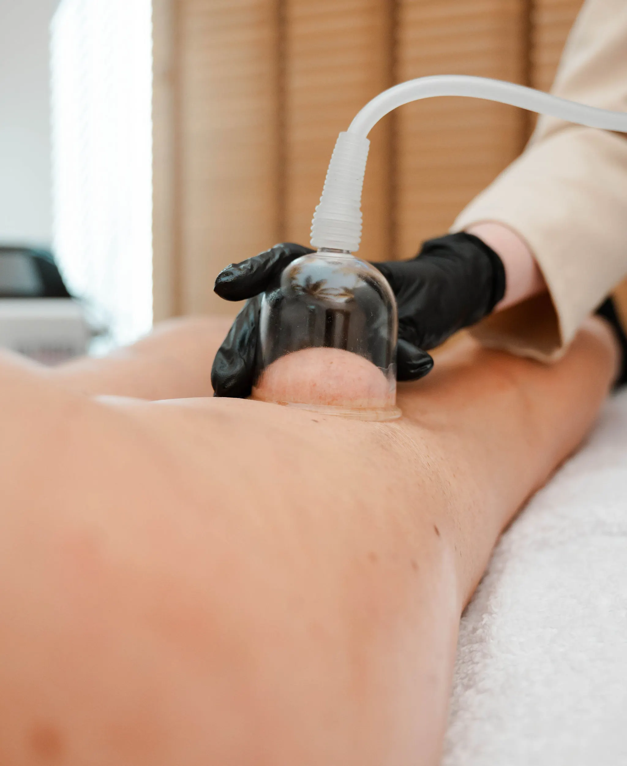 Cupping lichaamsbehandeling op de benen om de doorbloeding te verbeteren en cellulite te verminderen.
