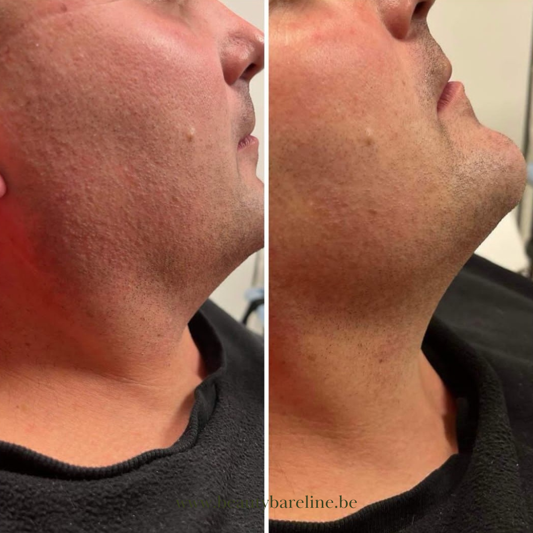 Vergelijkende voor- en nafoto van een HIFU-behandeling op de kaaklijn en kin. Het resultaat toont een strakkere huid en een meer gedefinieerde kaakcontour na de behandeling.