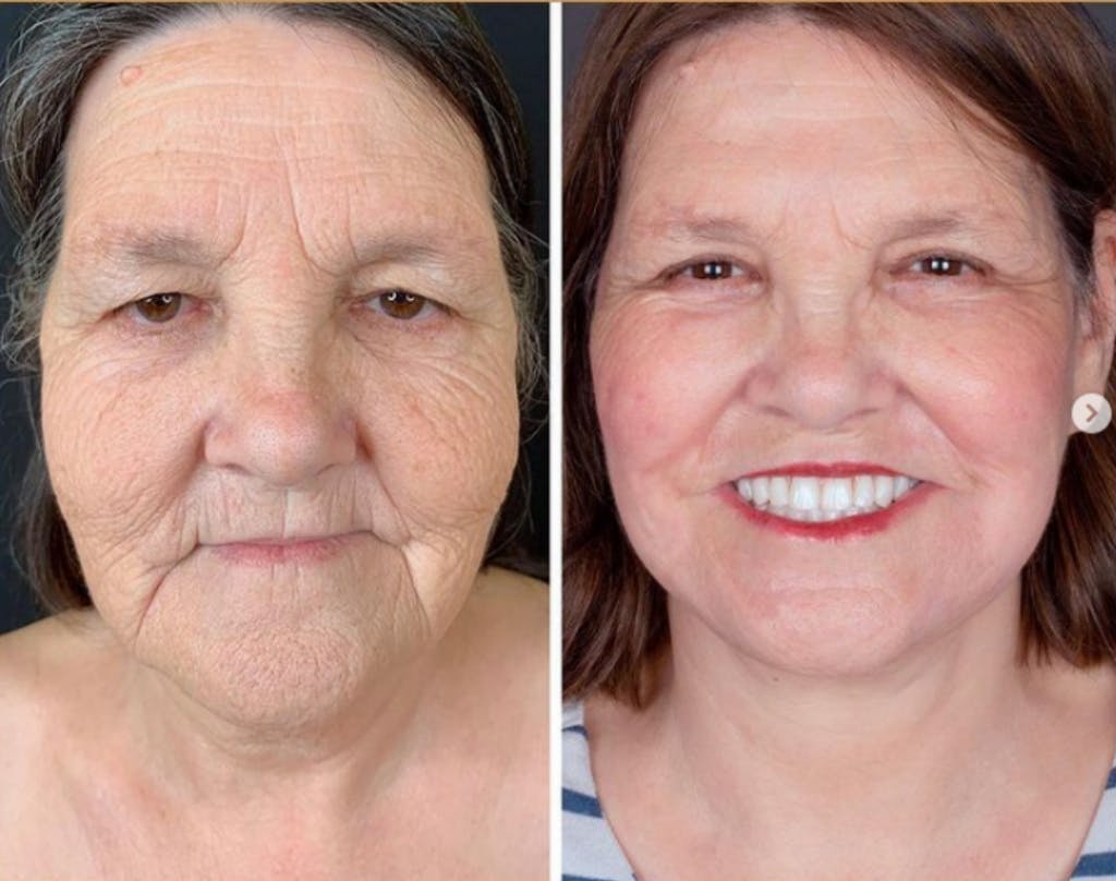 Antes e Depois, Resveratrol Americano. (Foto: Reprodução/Murilo Serra G1).