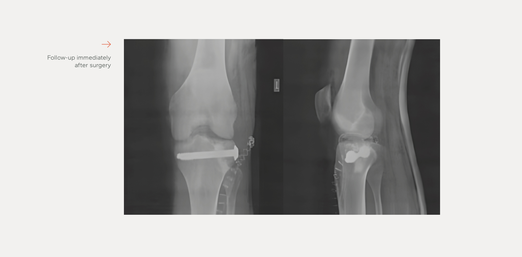 Neobone® Clinical Case 1