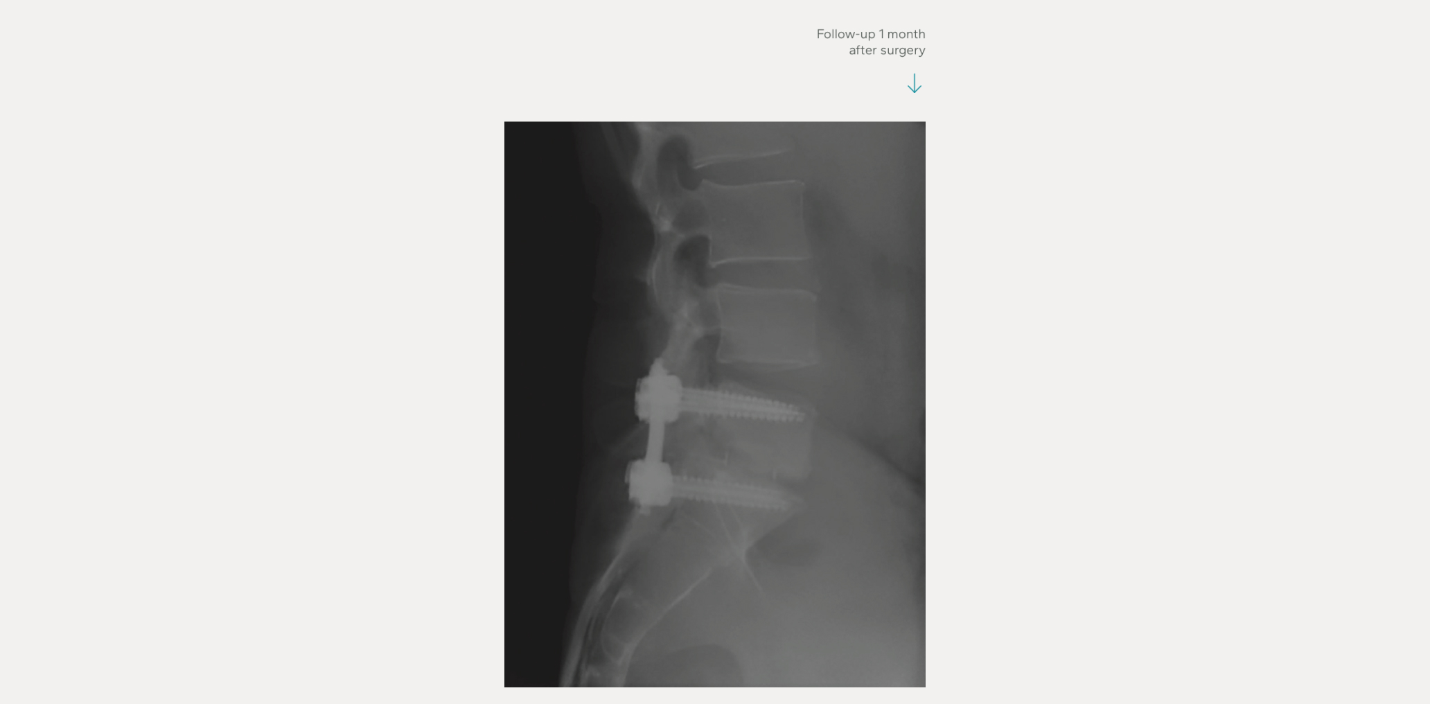 Bioceramed News & Events | Latest Innovations in Orthobiologics