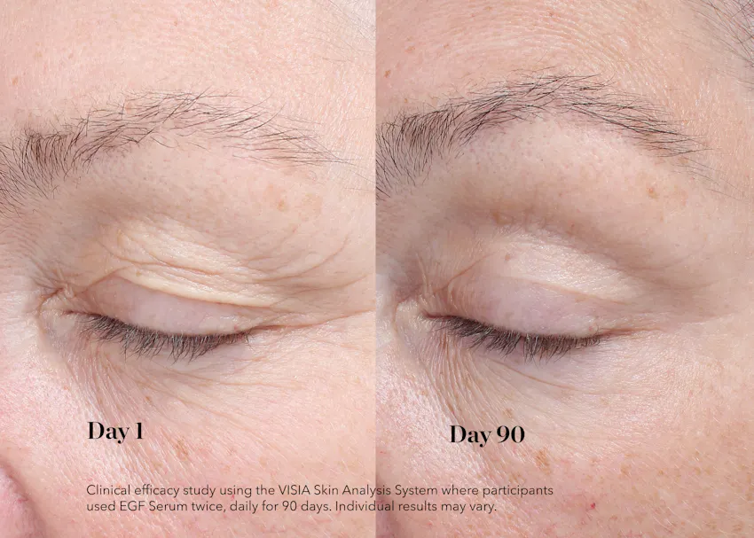 Before and after comparison of eye area showing reduced fine lines after 90 days of using BIOEFFECT EGF Serum