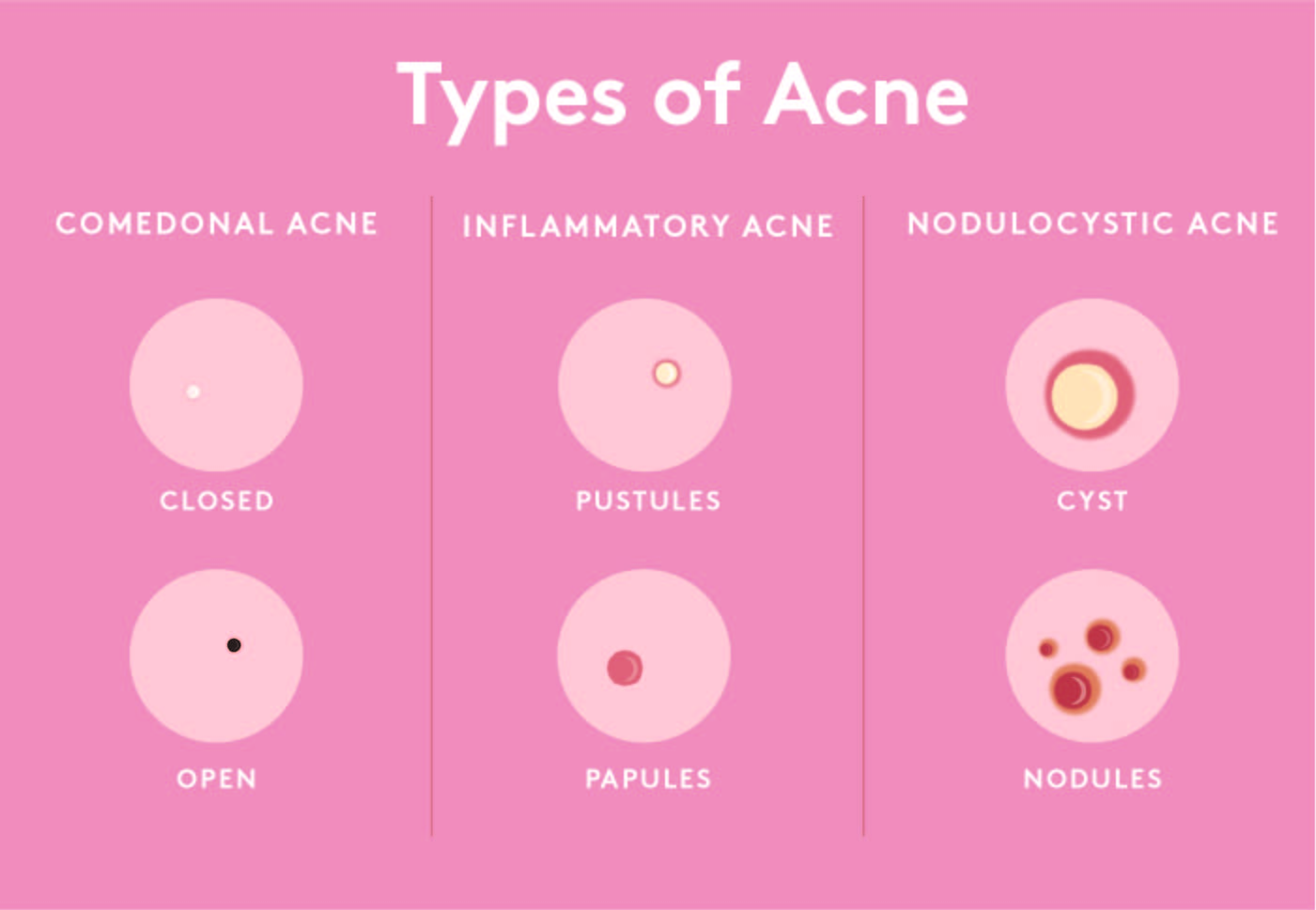 Different types store of acne