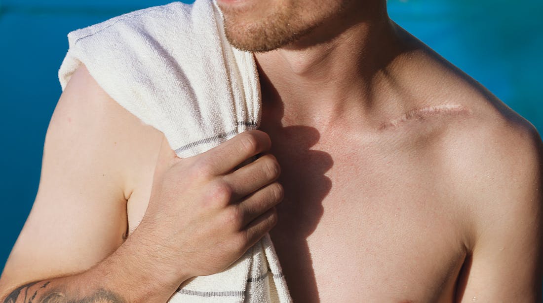 Image of a shirtless man near a pool with a towel over his shoulder, a scar is visible on his chest.