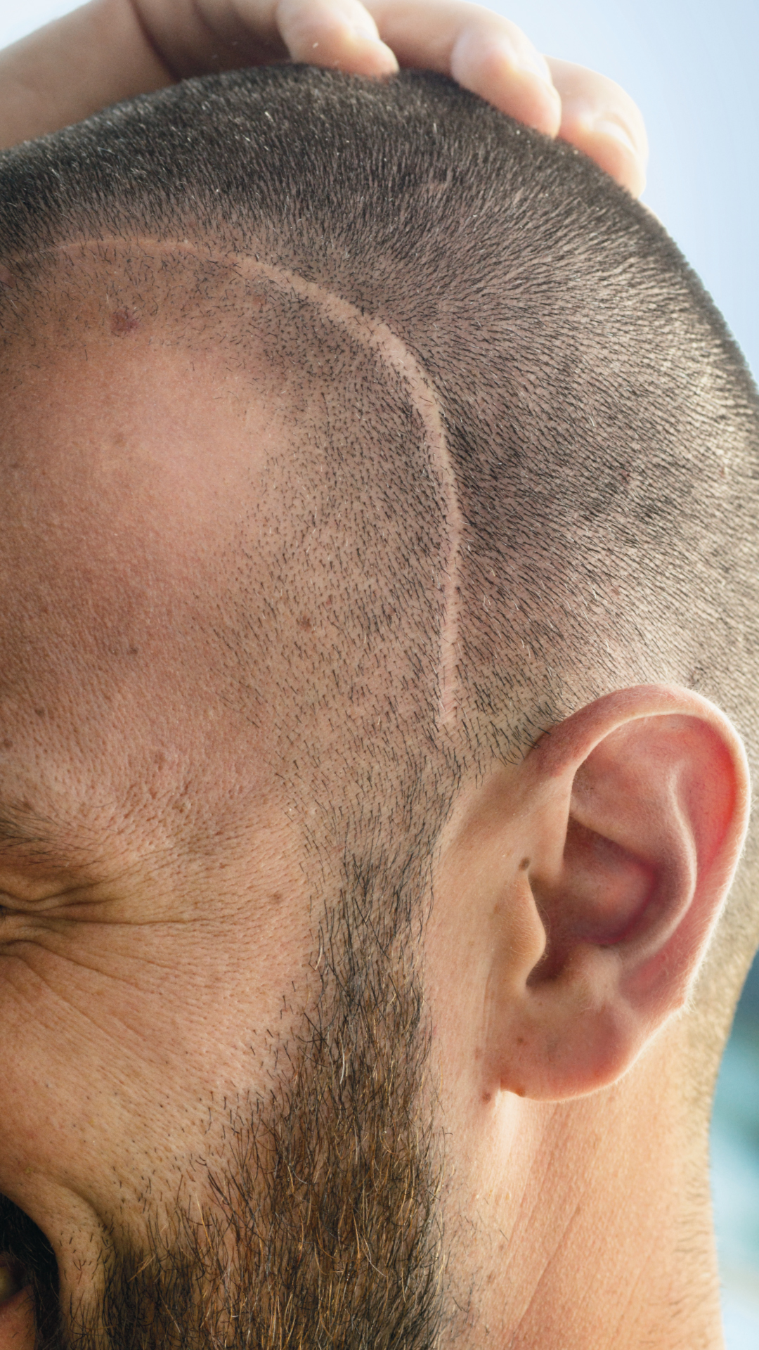 An image of a man with a shaved head showing a large scar.