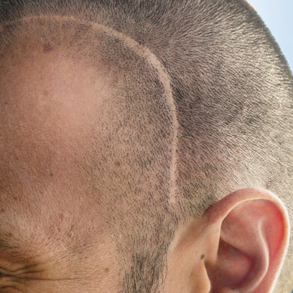 An image of a man with a shaved head showing a large scar.