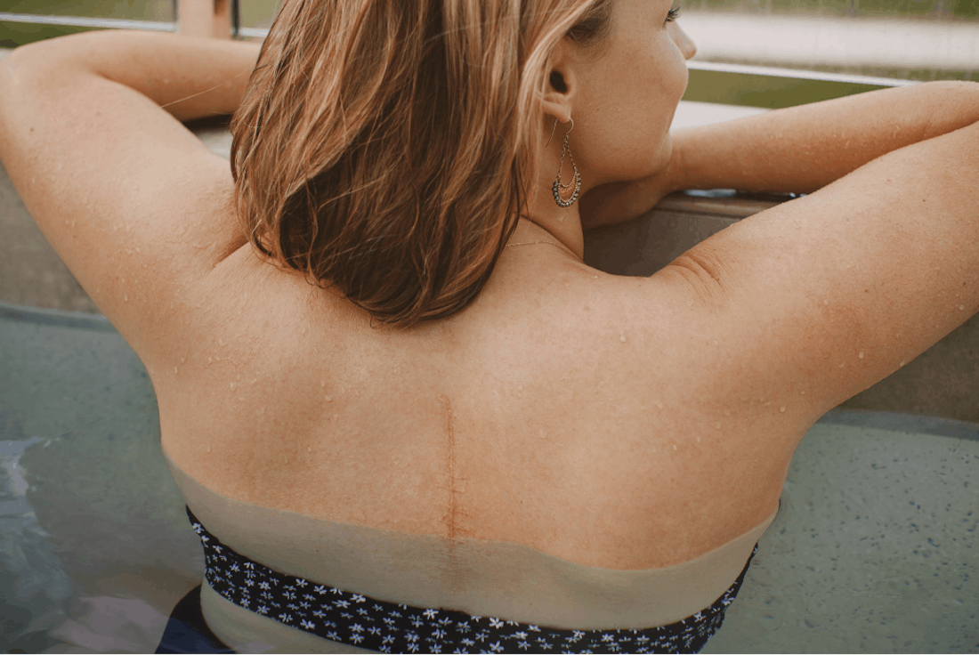 An image of a woman resting on the side of a pool, a scar is visible on her back.