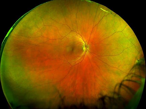 optos scan of retina 