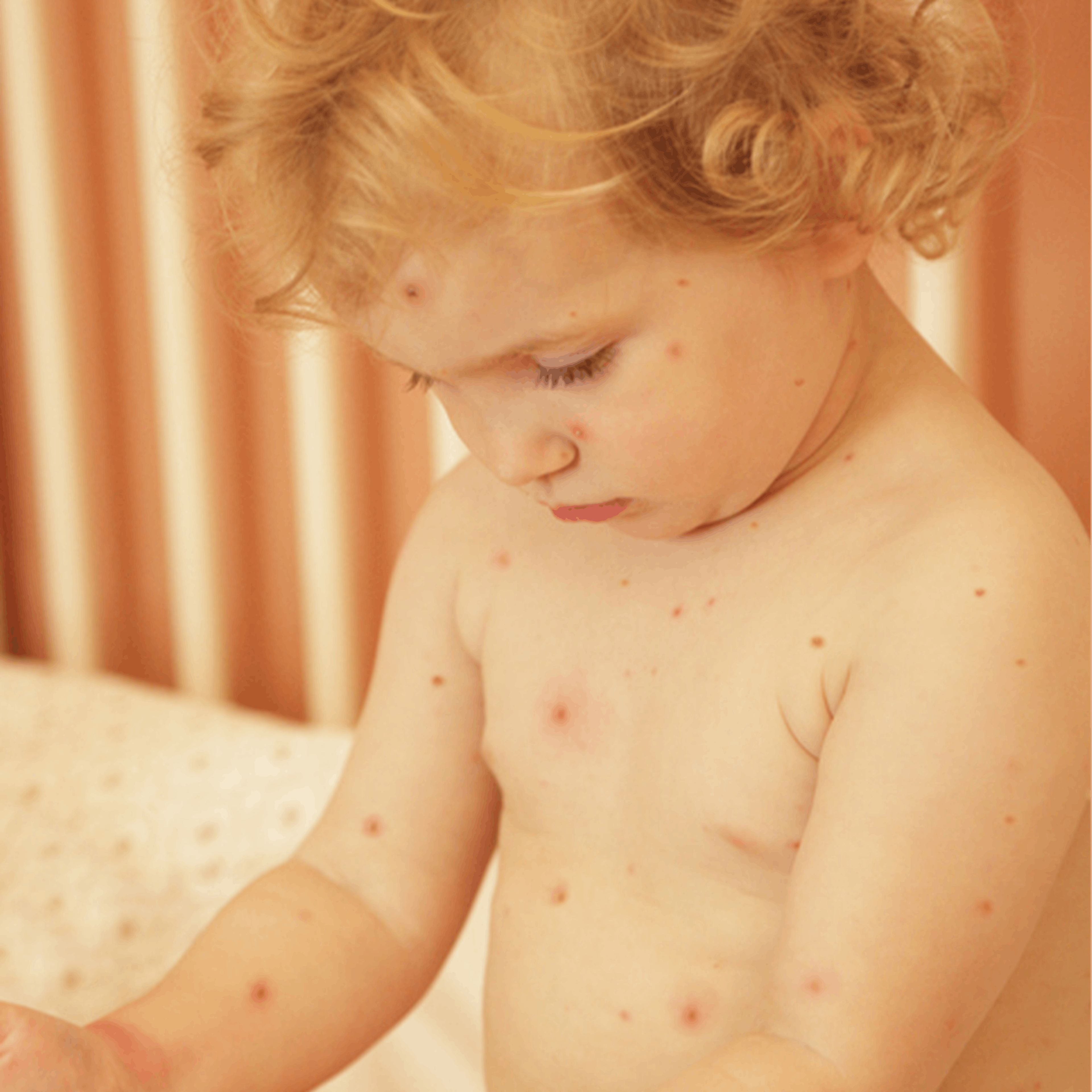 enfant varicelle