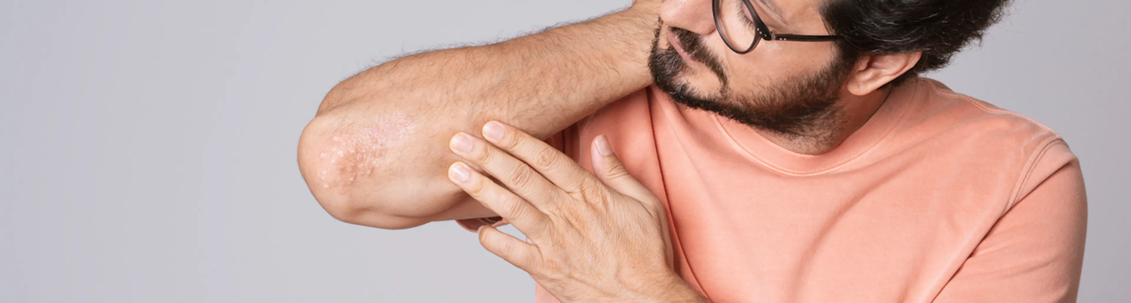 Uomo si si guarda il gomito dove ha uno sfogo di psoriasi 