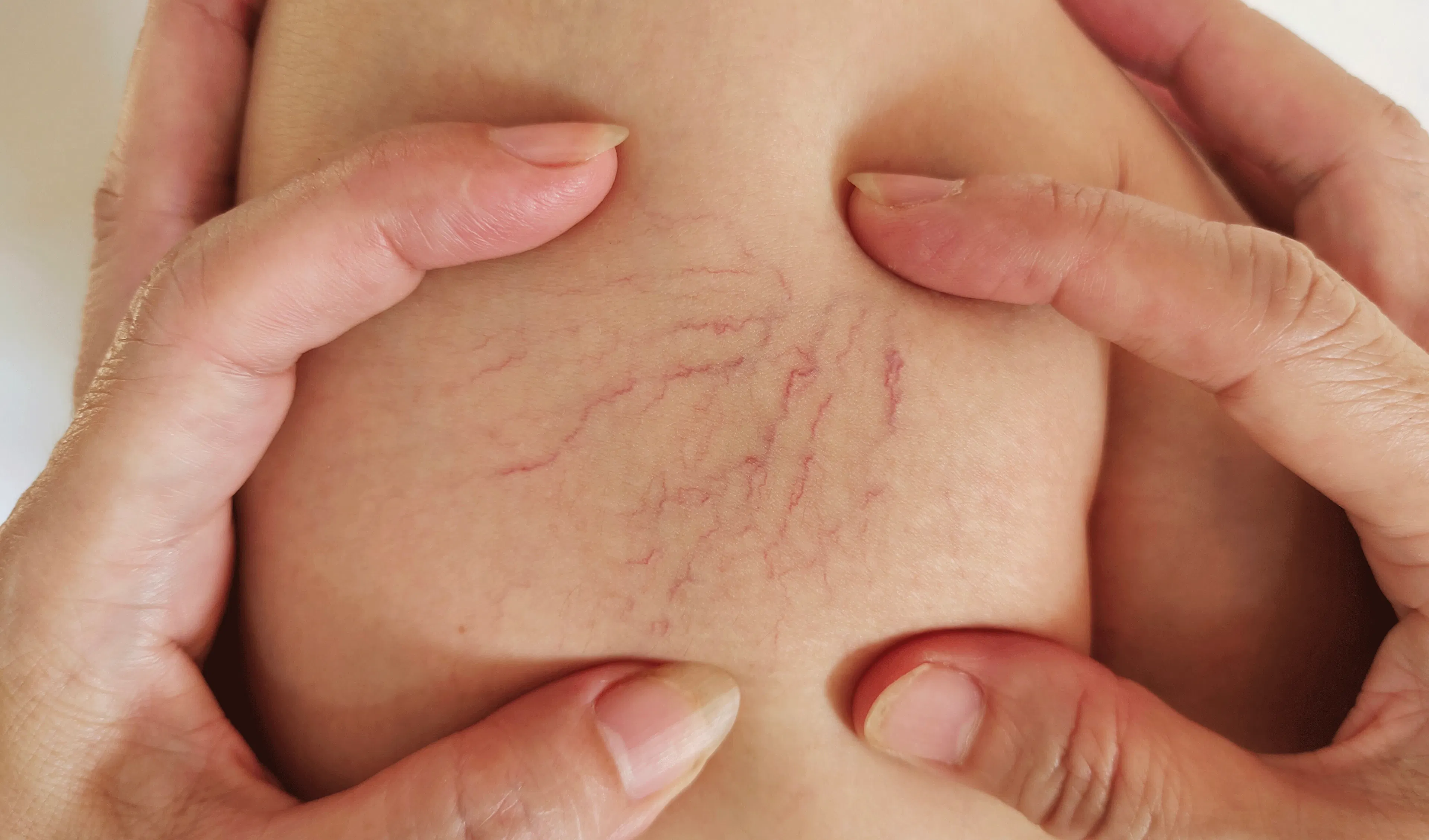 varices boiron homéopathie