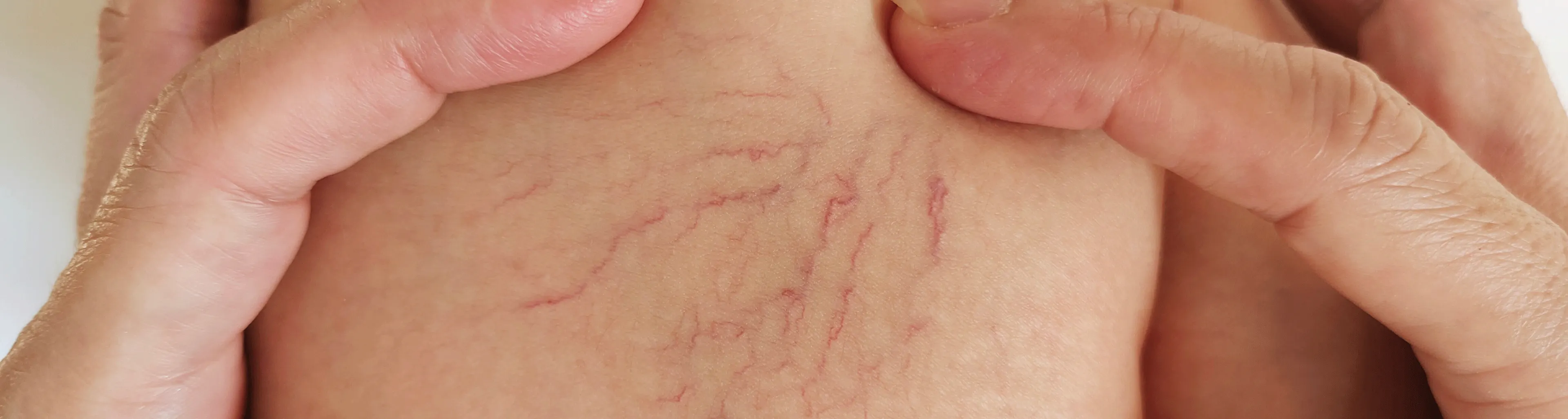 varices boiron homéopathie