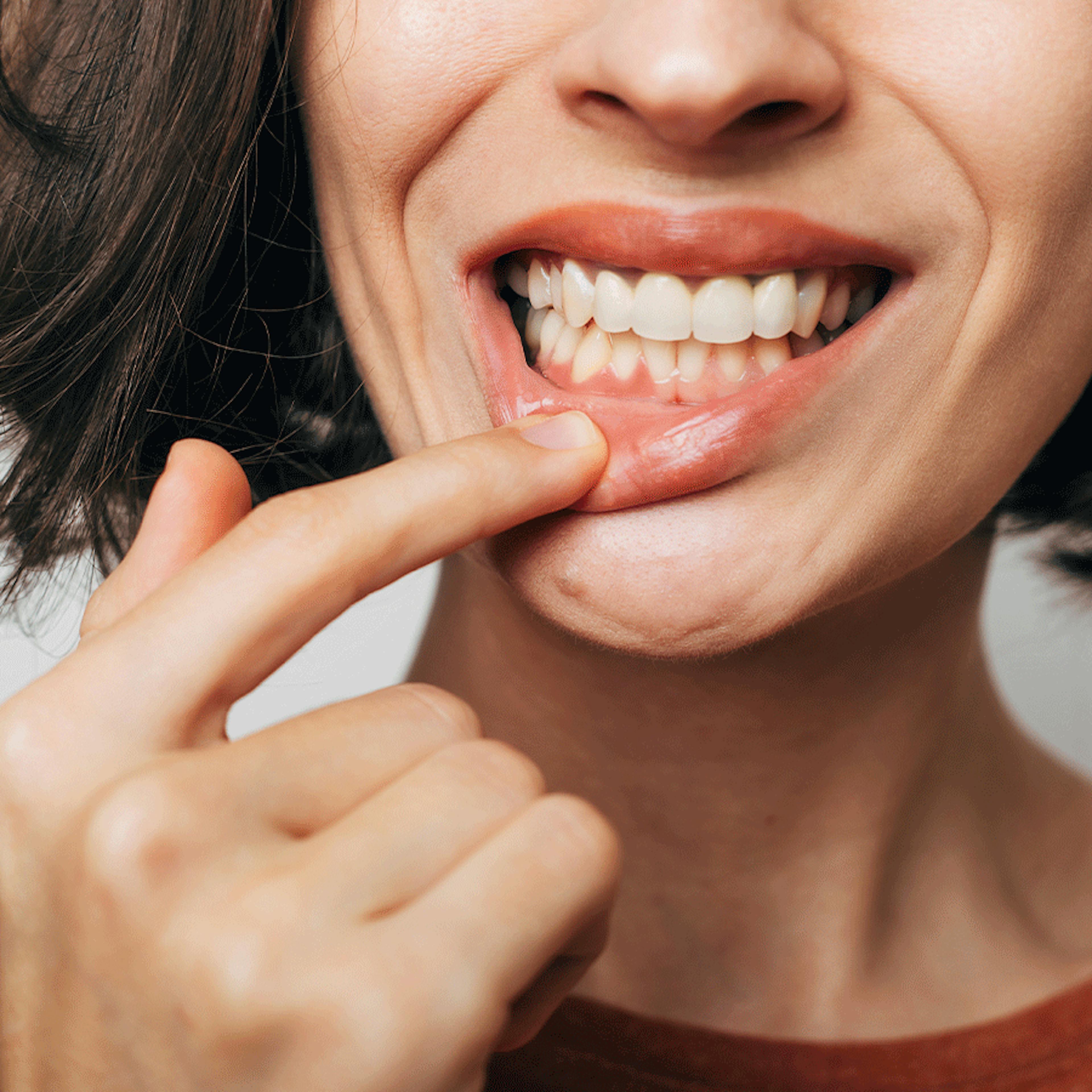 retractation gingivale homéopathie