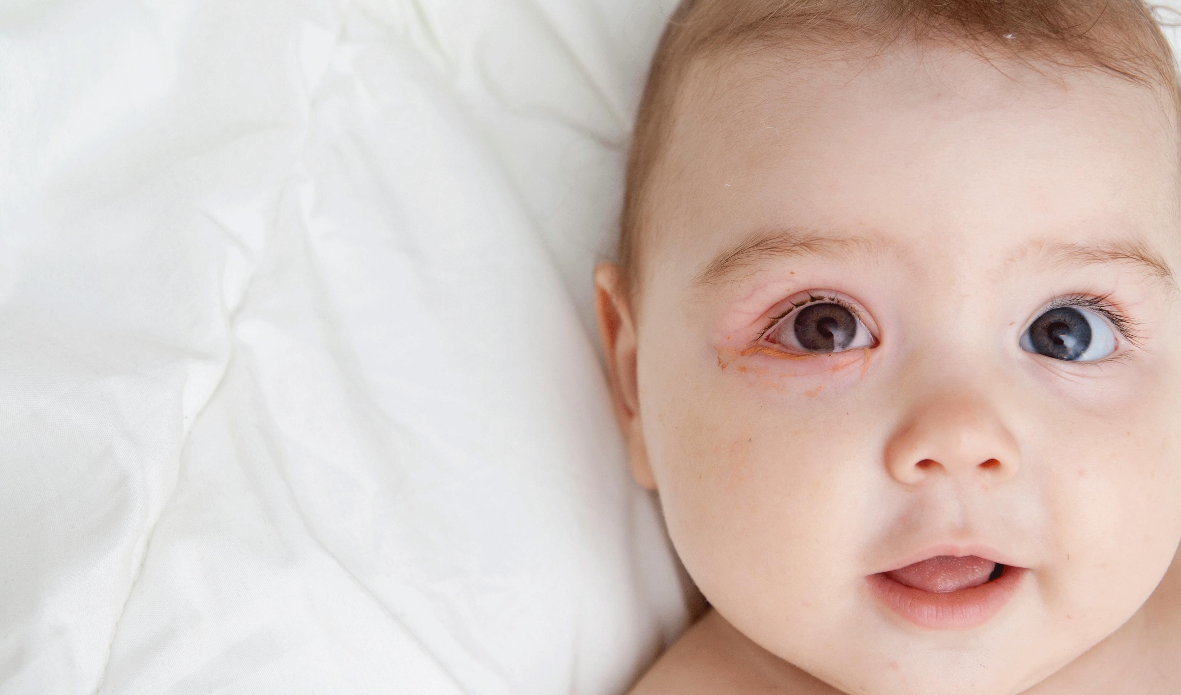 conjonctivite bébé