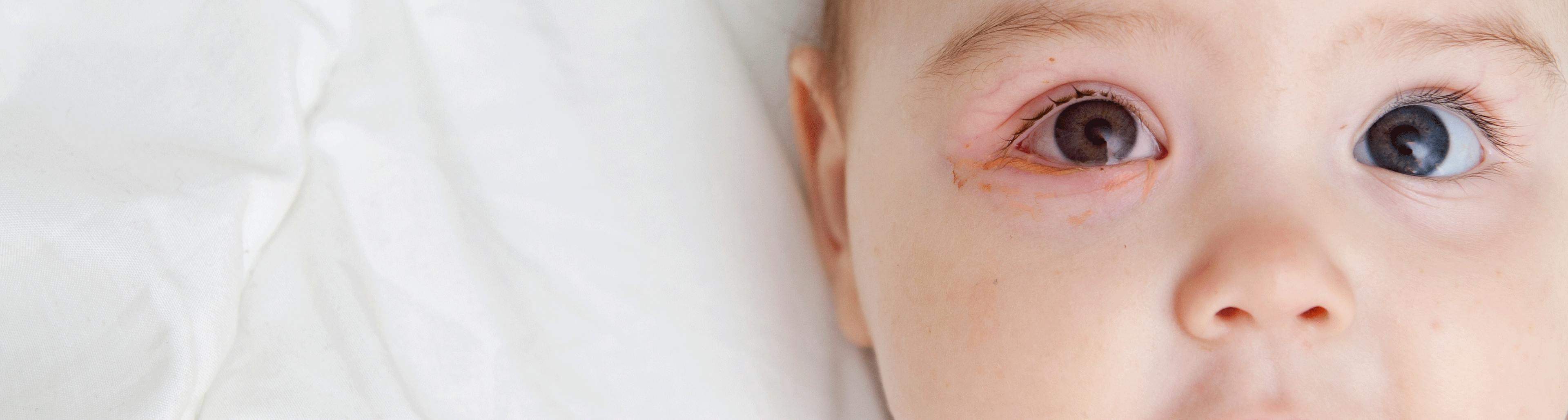conjonctivite bébé