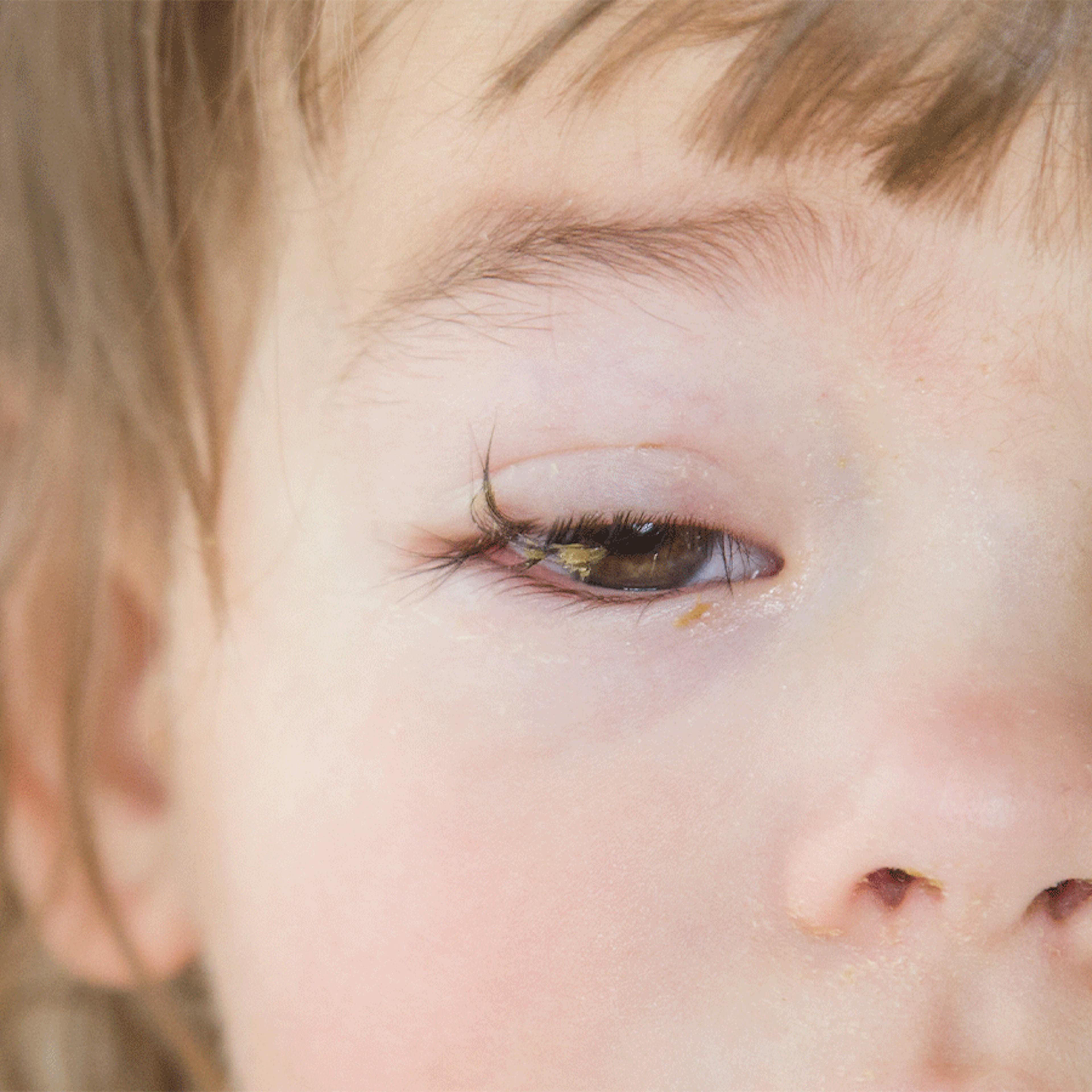 contagion conjonctivite enfant
