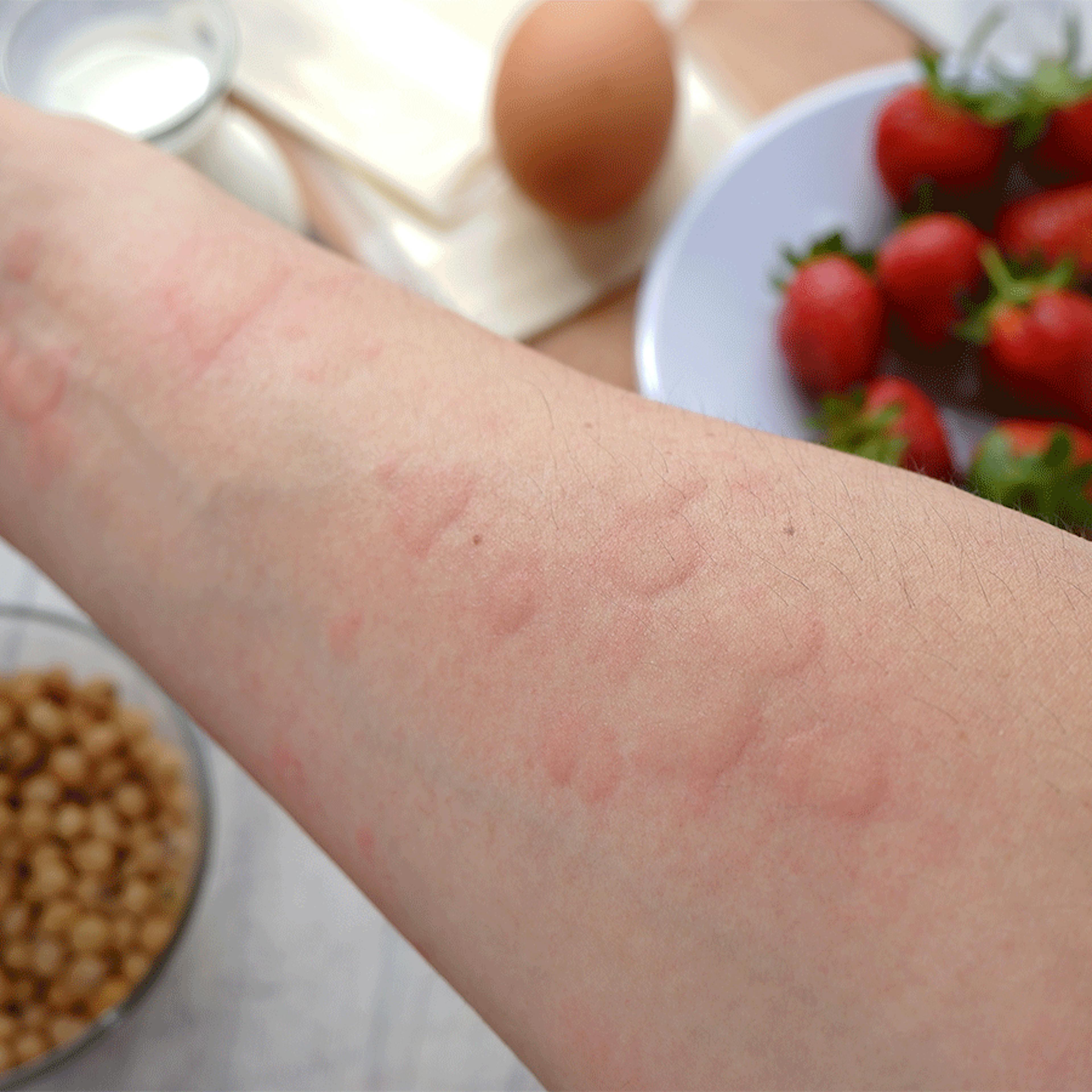urticaire aliments allergies boiron