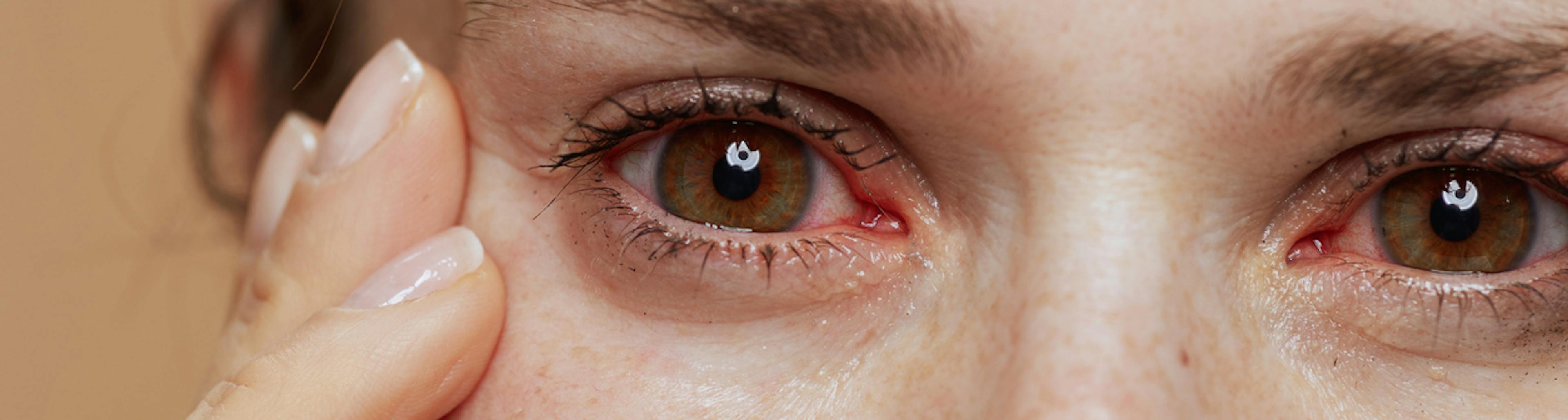 Primo piano di donna con occhi secchi e arrossati